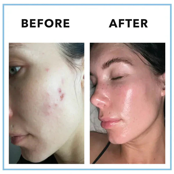 CLEARSTEM MINDBODYSKIN™ Vitamin Supplement – Hormonal Acne & Skin Balance Formula – 90 Capsules